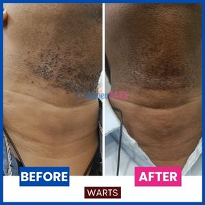 Before and after image of warts on neck. After image shows warts gone through homeopathic treatment for warts.